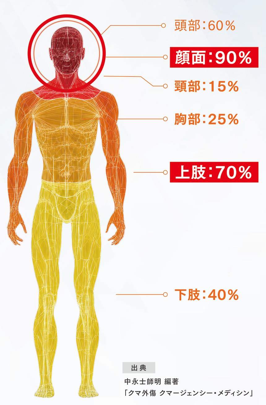 クマ被害の受傷部位分布：顔面90%、上肢70%、頭部60%、下肢40%、胸部25%、頸部15%